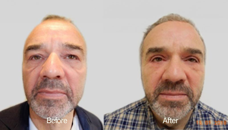 Eyelid Surgery Results - Facial Perfection