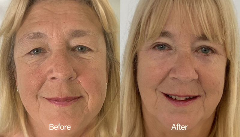 Eyelid Surgery Results - Facial Perfection