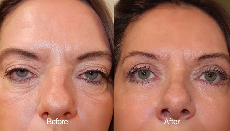 Eyelid Surgery Results - Facial Perfection