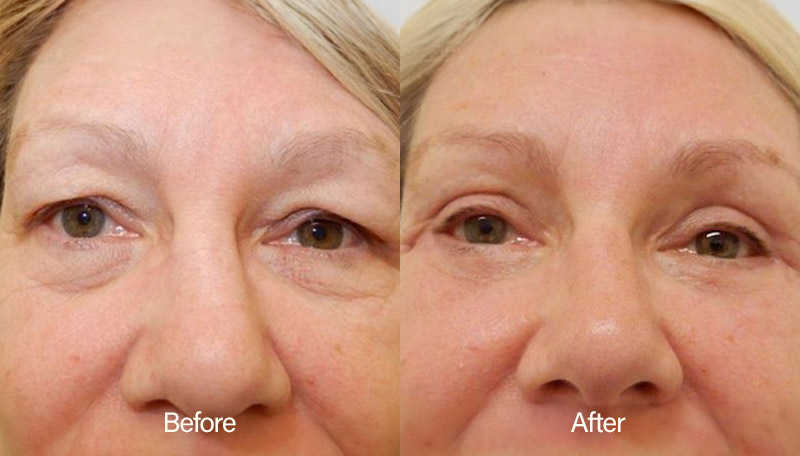 Eyelid Surgery Results - Facial Perfection