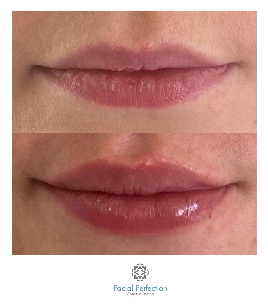 Lip enhancement Derby
