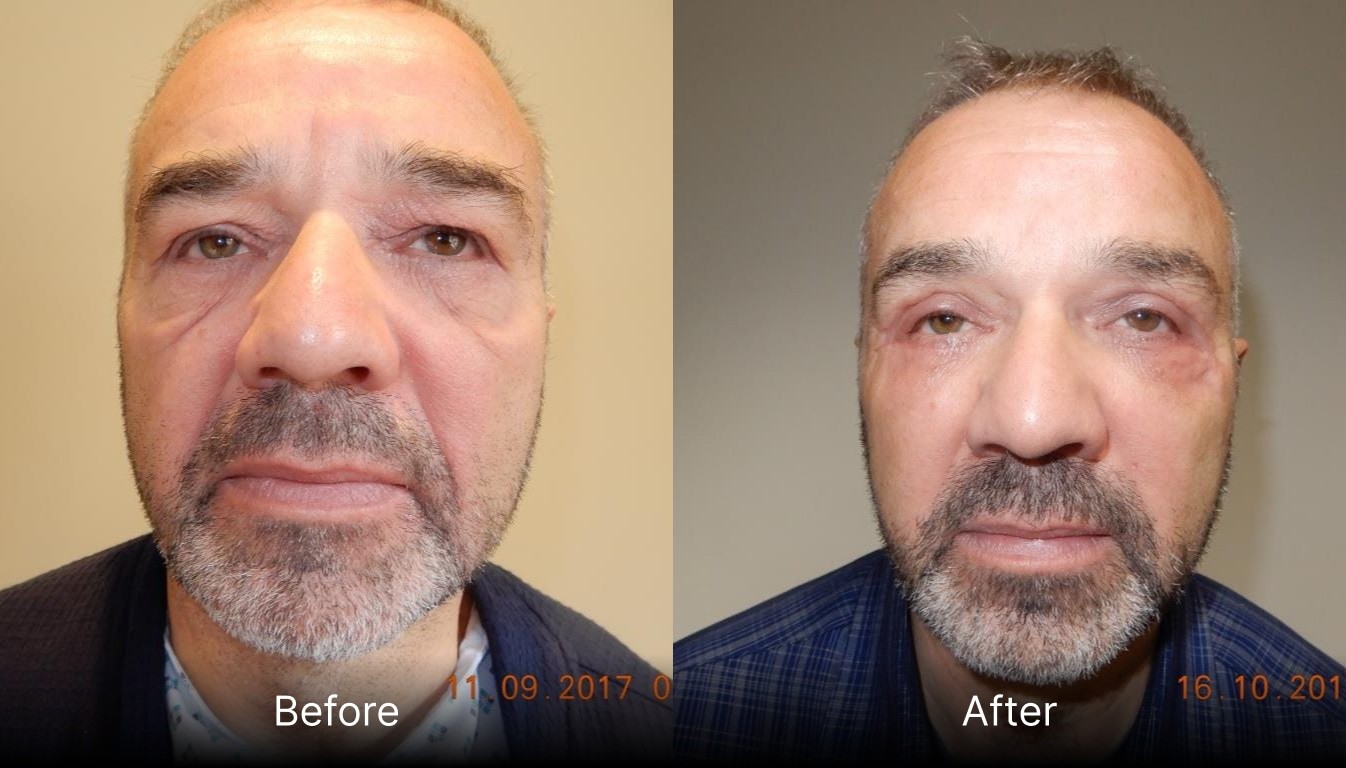Before and after blepharoplasty treatment