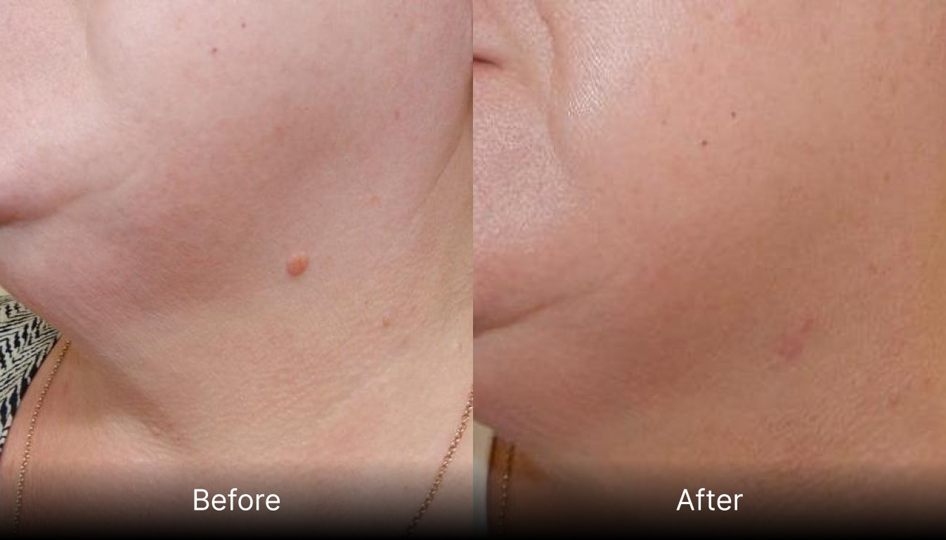 Before and after results