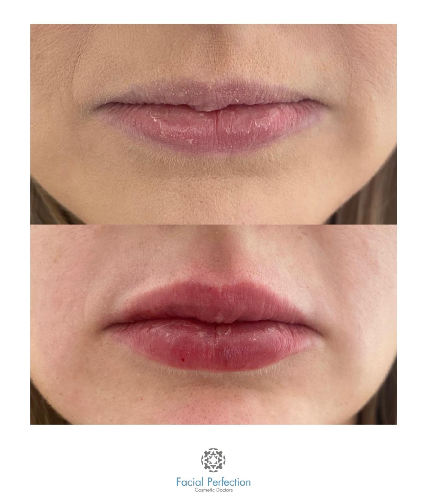 non surgical facelift Derby