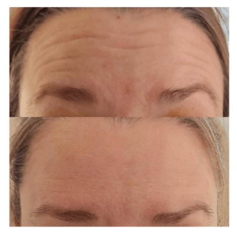 Why Anti-Wrinkle Injections Alone Won't Restore a Tired Face