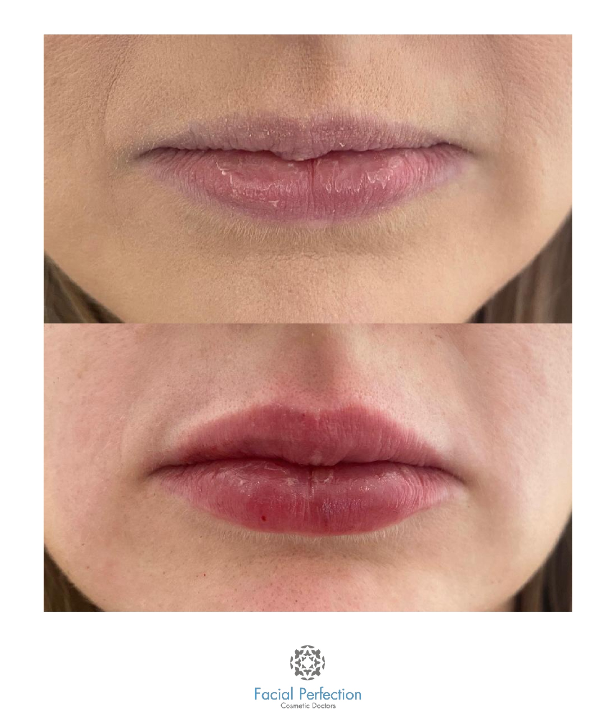 Lip Fillers Before & After