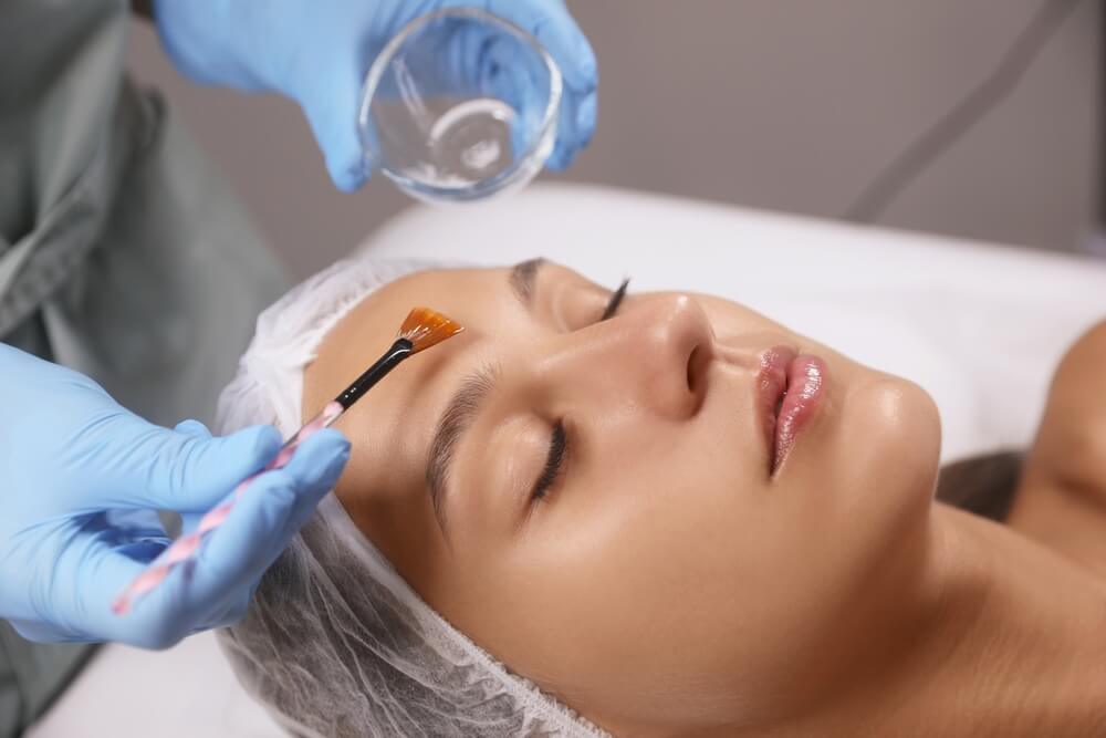 Chemical Peel Treatment - Facial Perfection