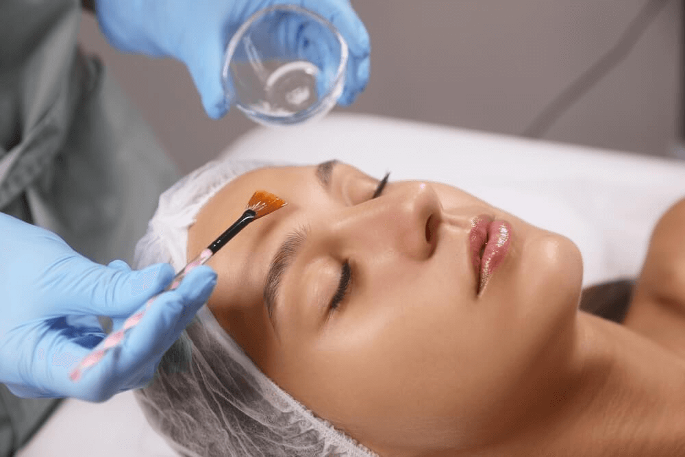 Chemical peel Derby
