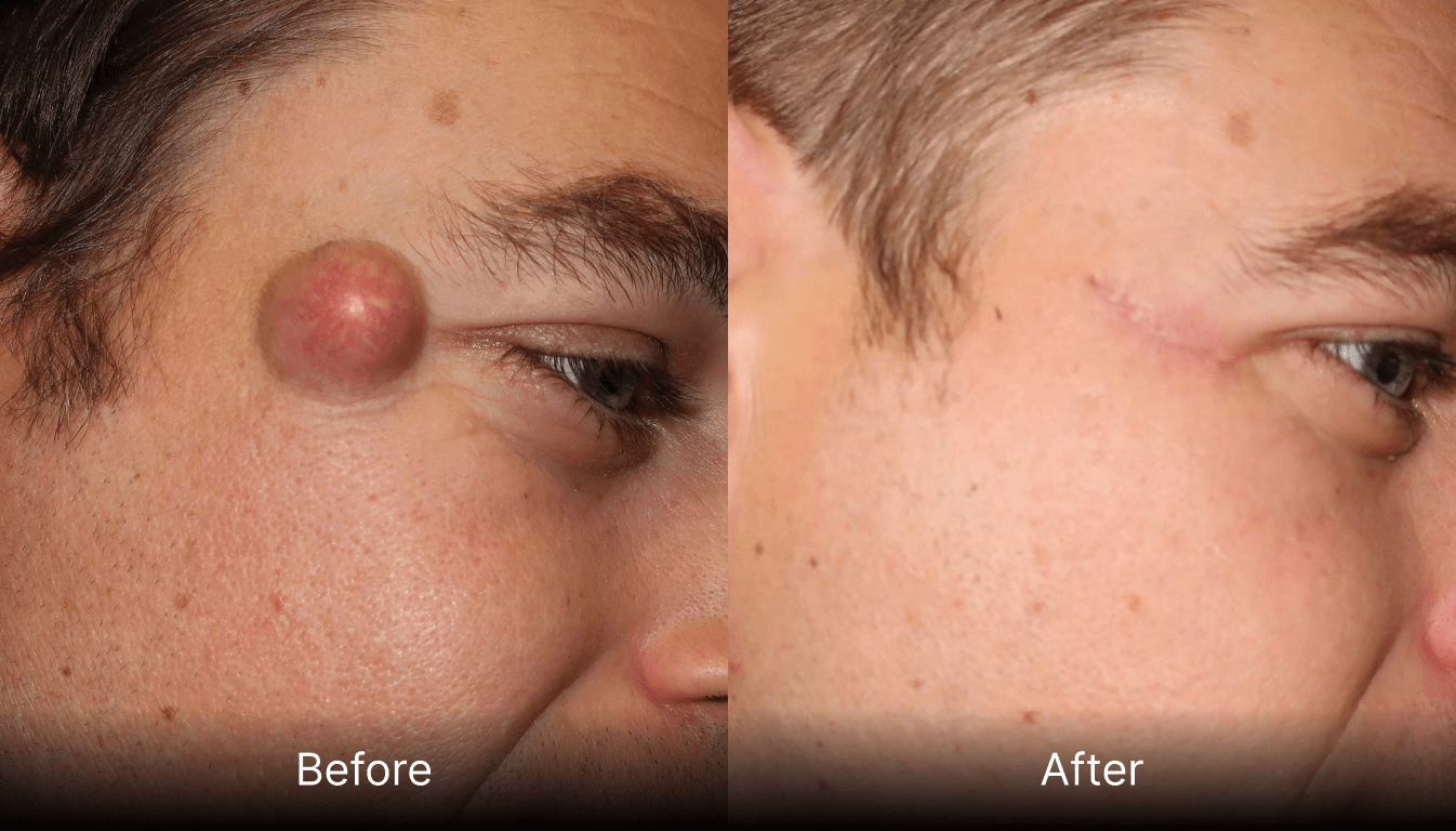 Cyst removal Derby