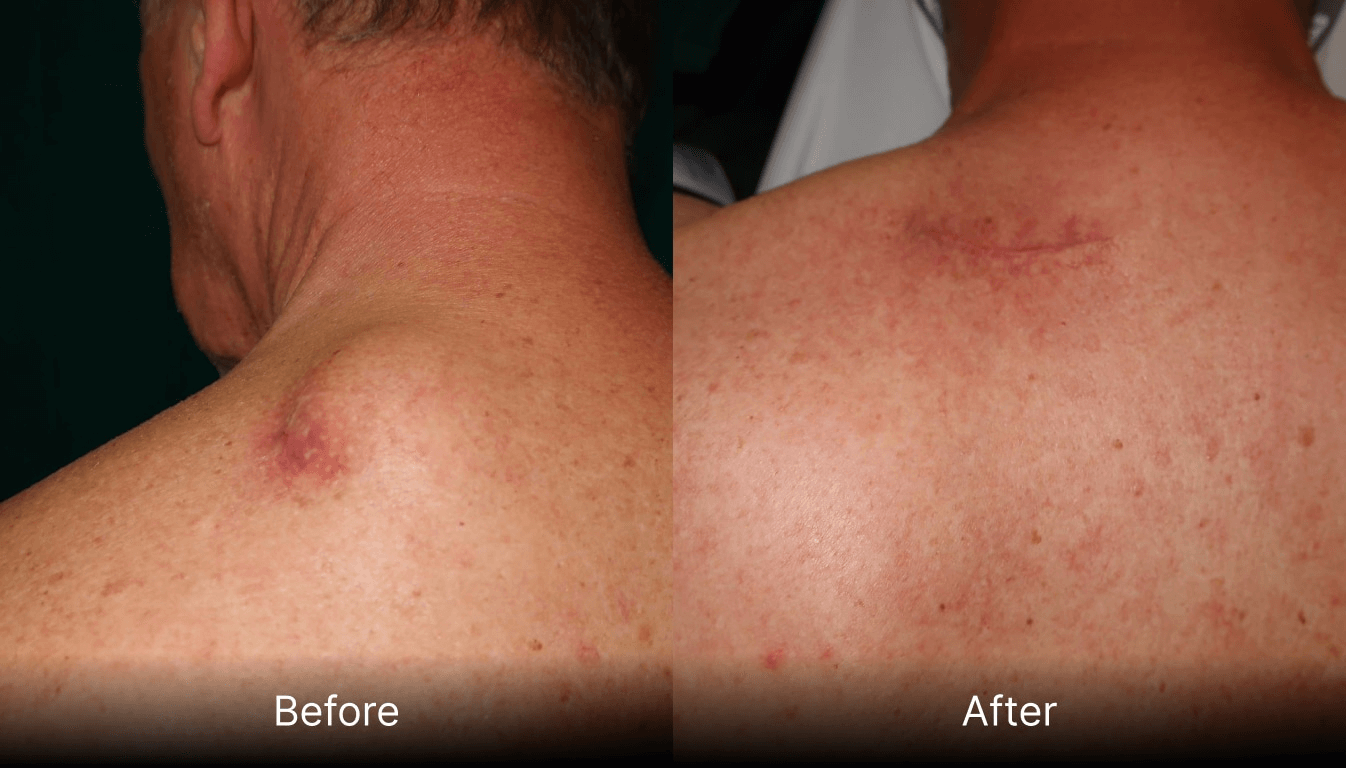 Cyst removal Derby