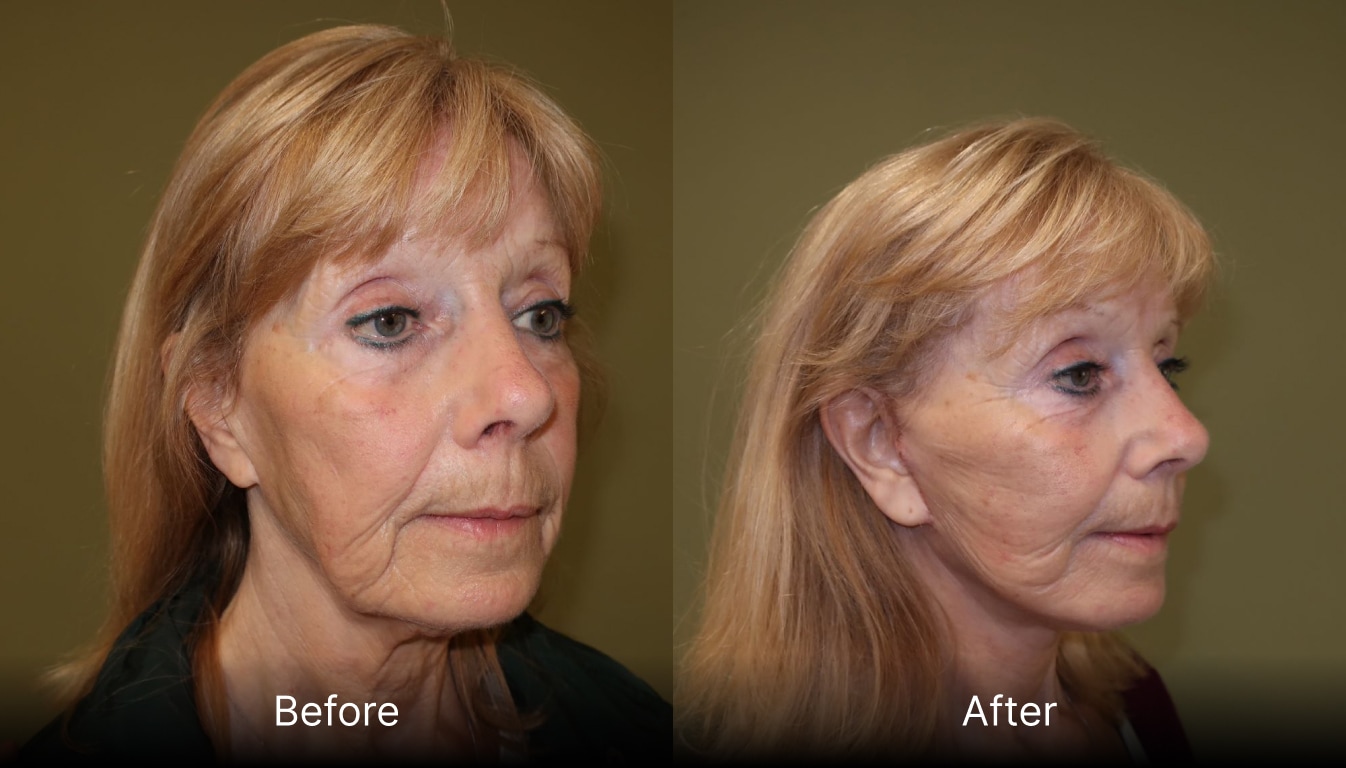 Twilight Facelift or Conscious Sedation Facelift