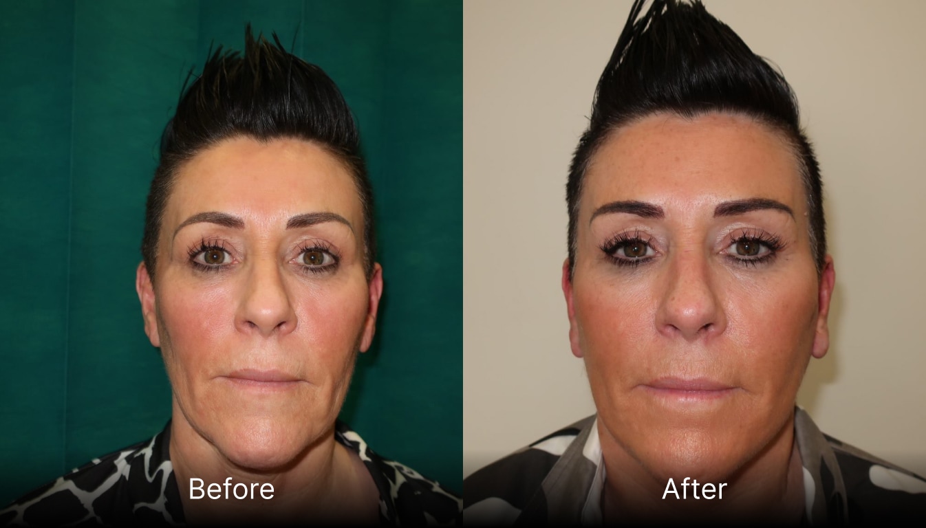 MACS Facelift