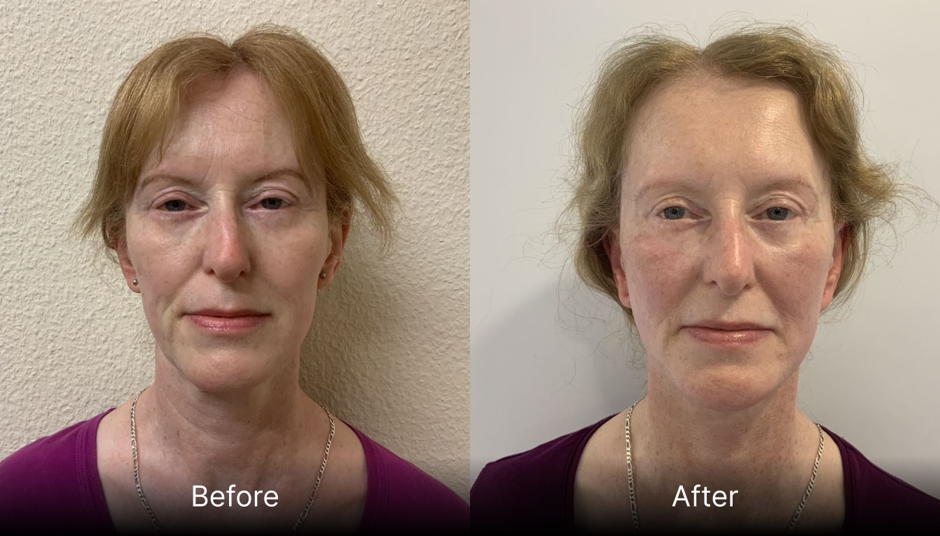 Facelift or Rhytidectomy