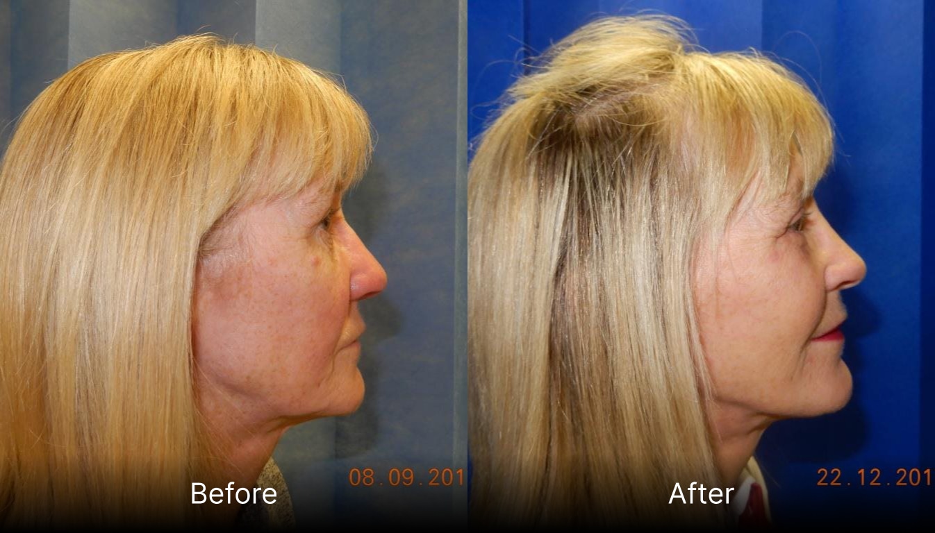 Volumetric Facelift
