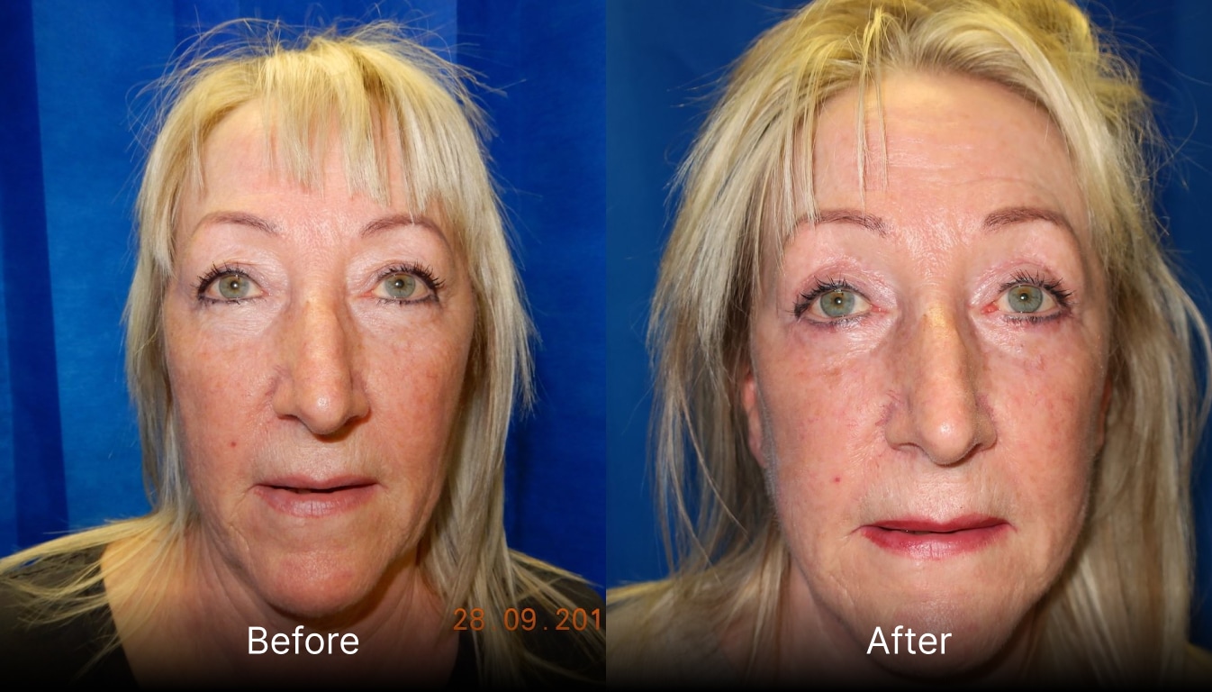 LA Facelift or Awake Facelift