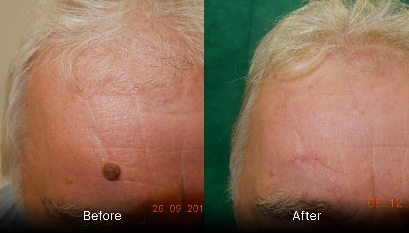 Skin Lesions, Moles, Sebaceous Cysts, Lipoma Removal