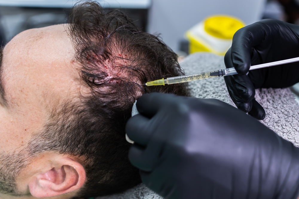 PRP hair loss in Derby
