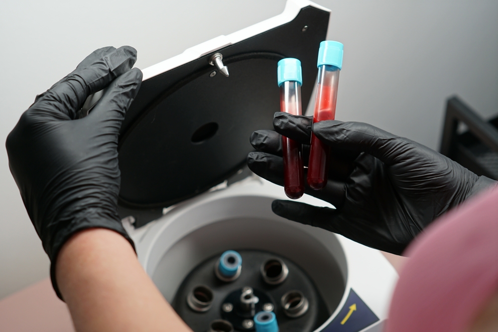 PRP Hair Loss Treatment