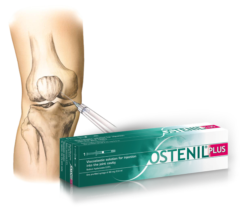 Ostenil Joint Injections