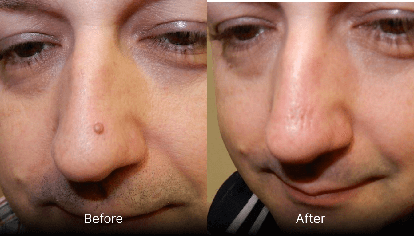 Lipoma removal Derby