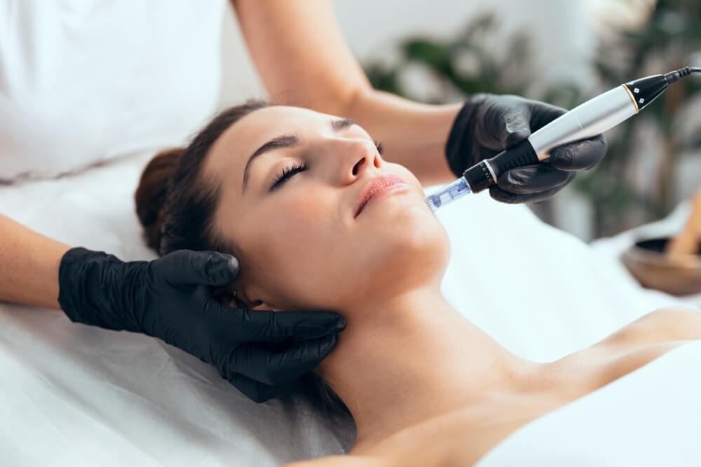 Microneedling Treatment - Facial Perfection