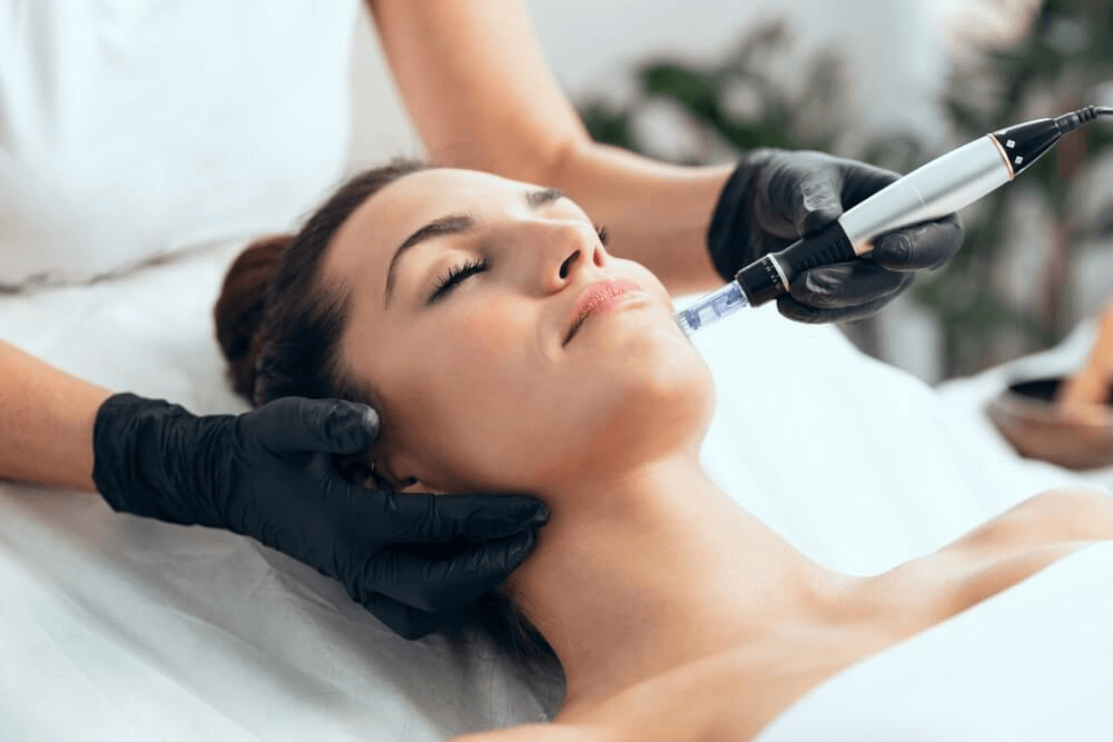 Microneedling in Derby