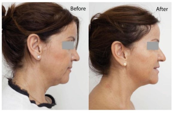 Profhilo treatment near me