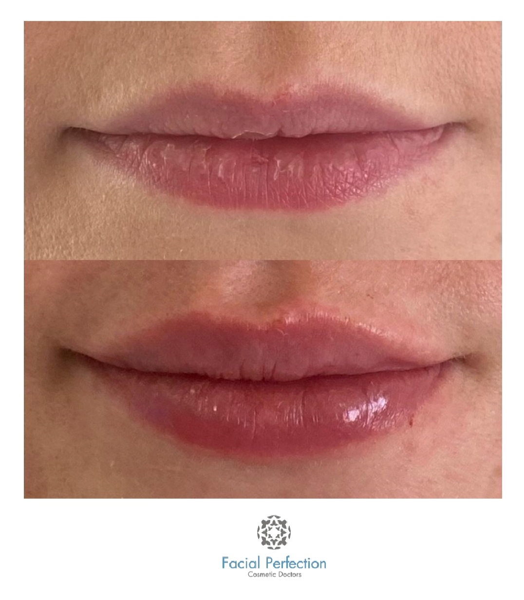 Dermal Before After