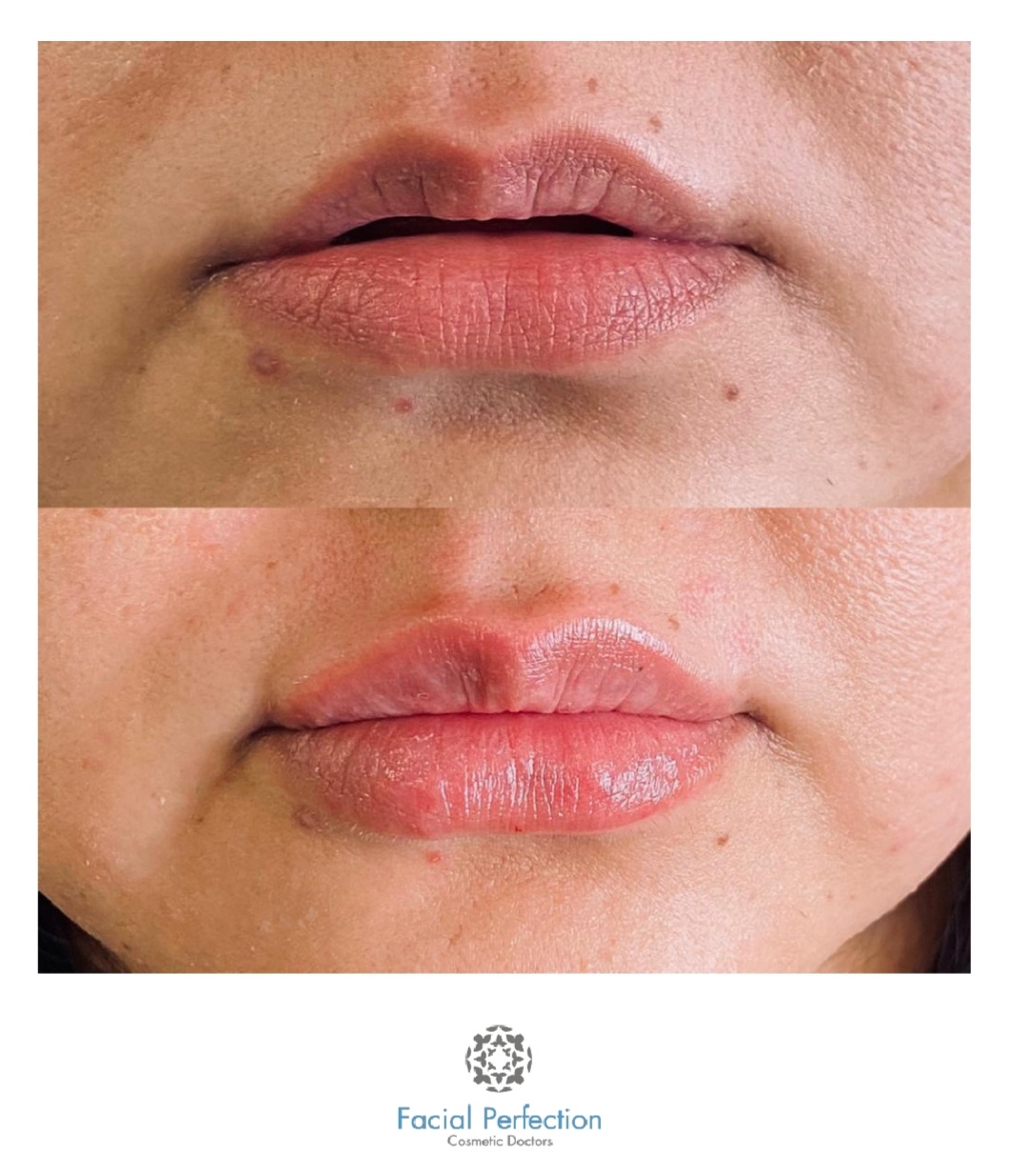 Lip Fillers Before & After