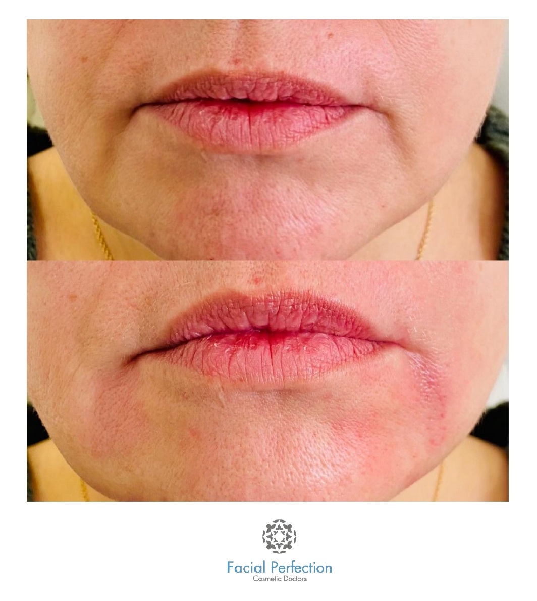 Lip Fillers Before & After