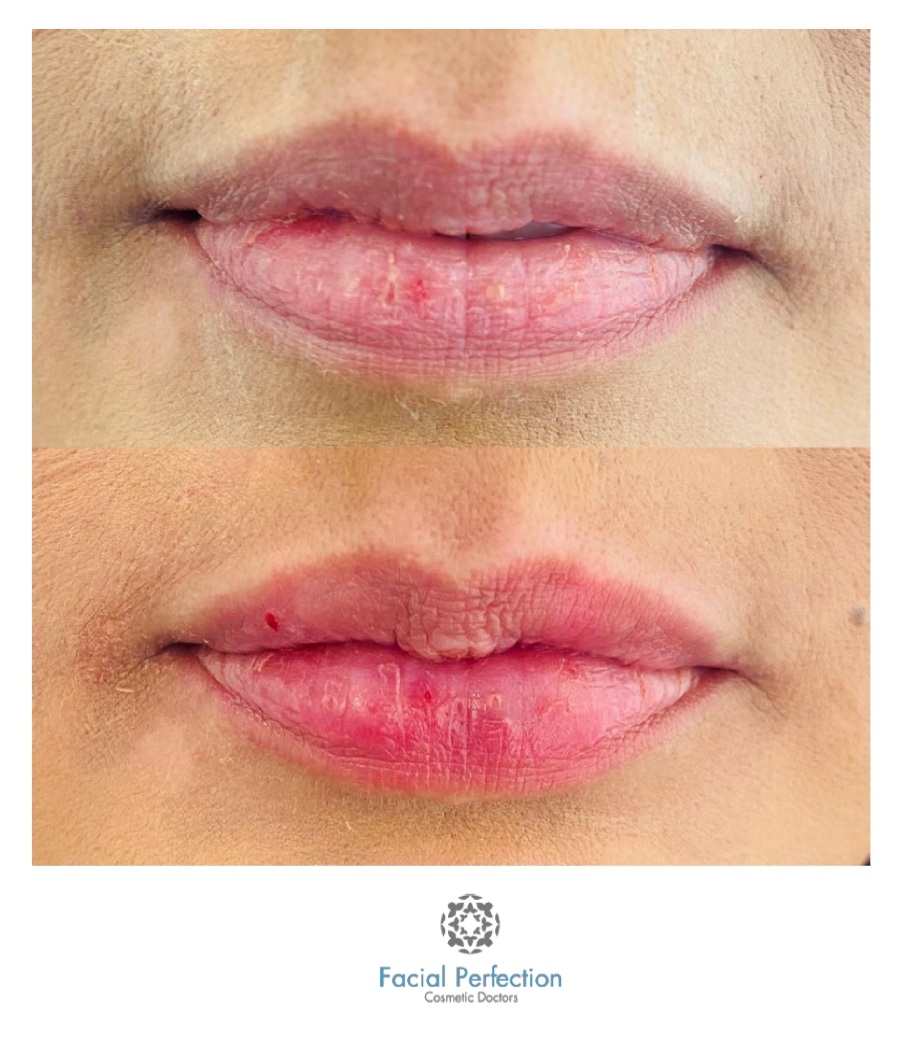 Lip Fillers Before & After