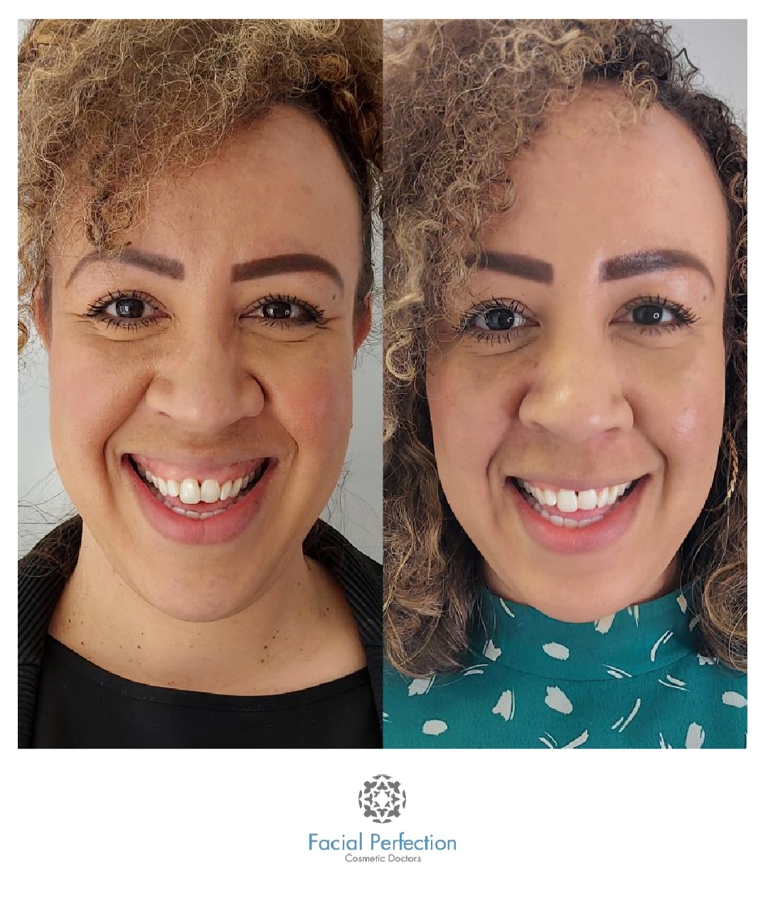 Gummy Smile Treatment