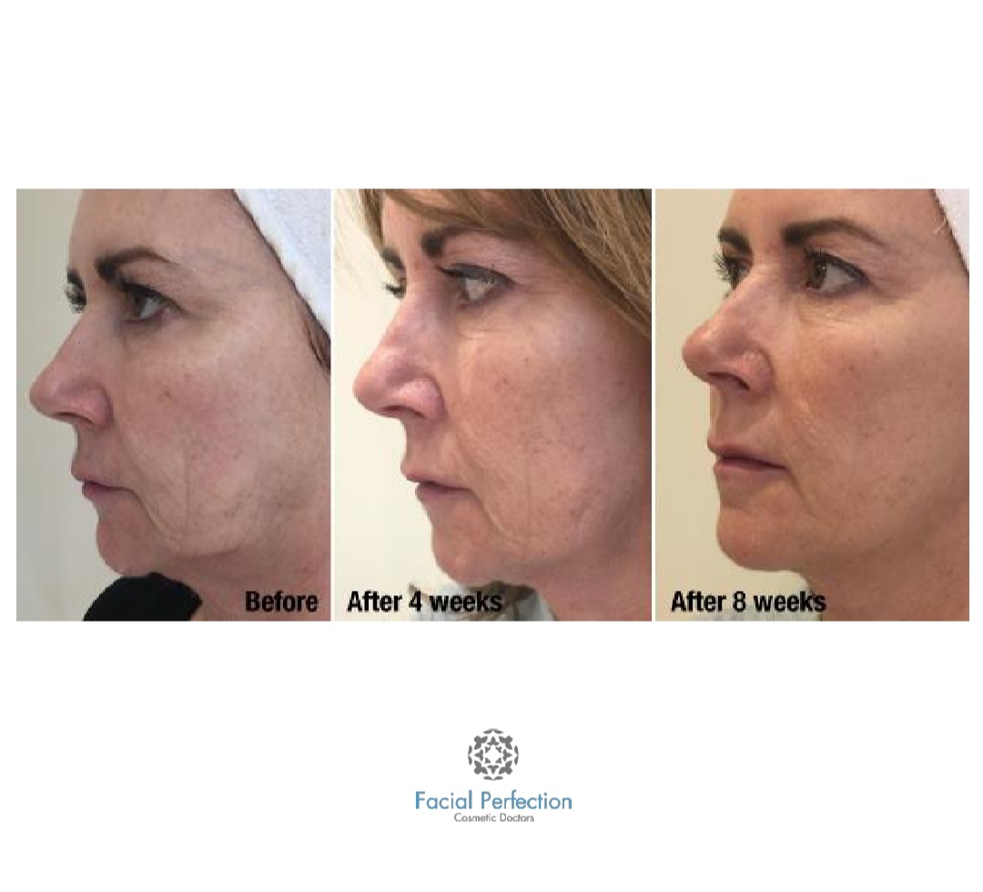 Profhilo Before & After 