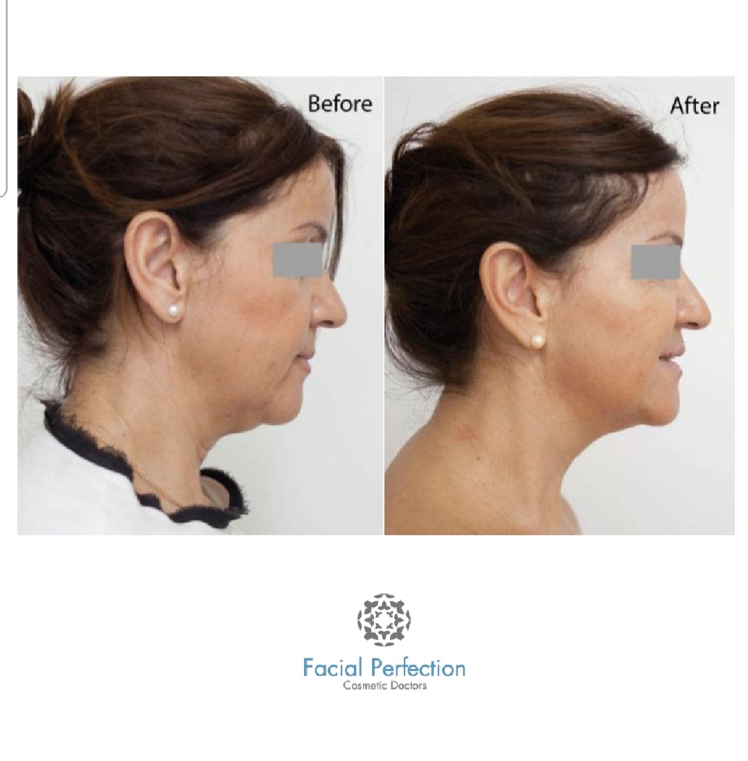Profhilo Before & After 