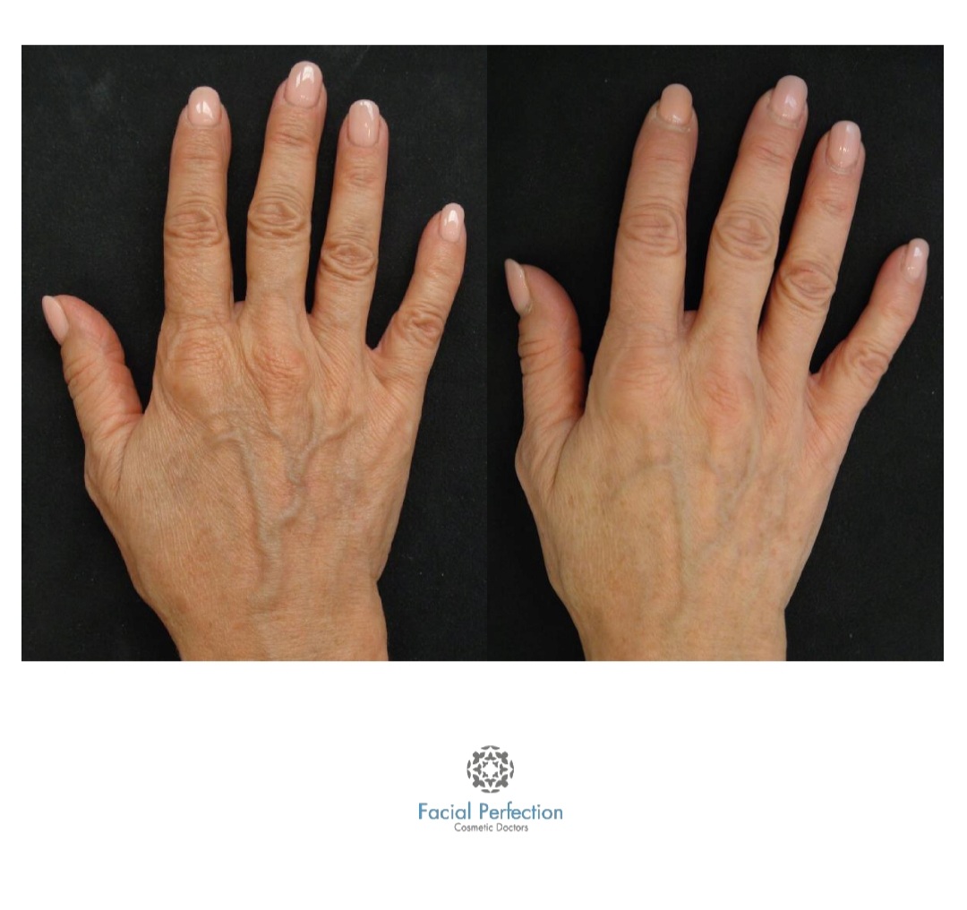 Profhilo Before & After 