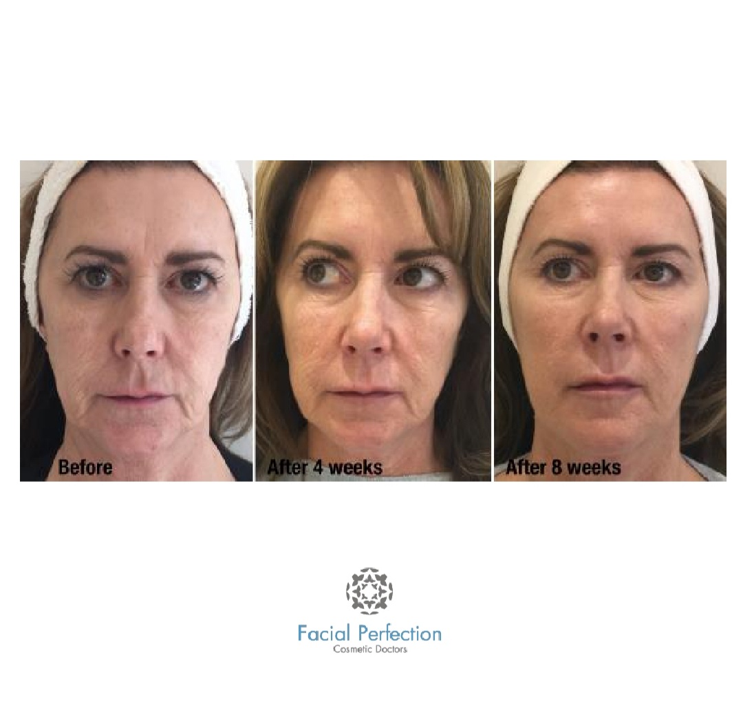 Profhilo Before & After 