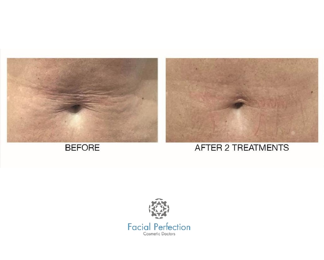 Profhilo Before & After 