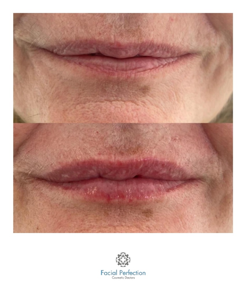 Lip Fillers Before & After