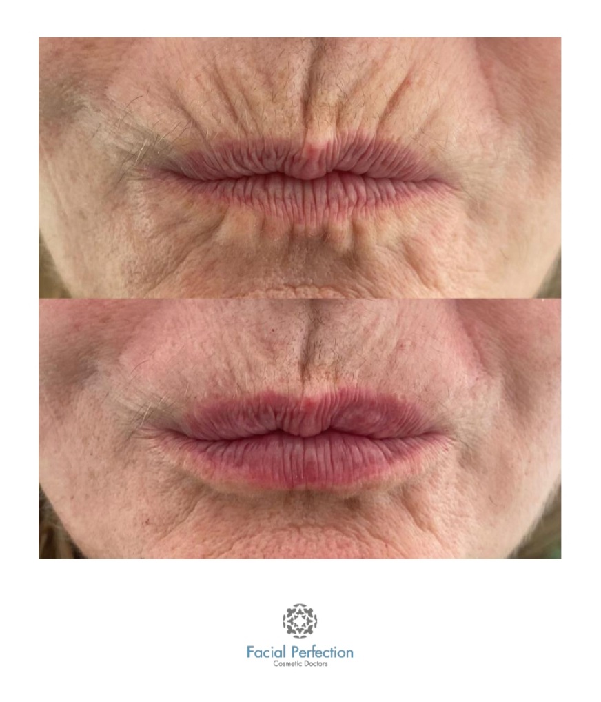 Lip Fillers Before & After
