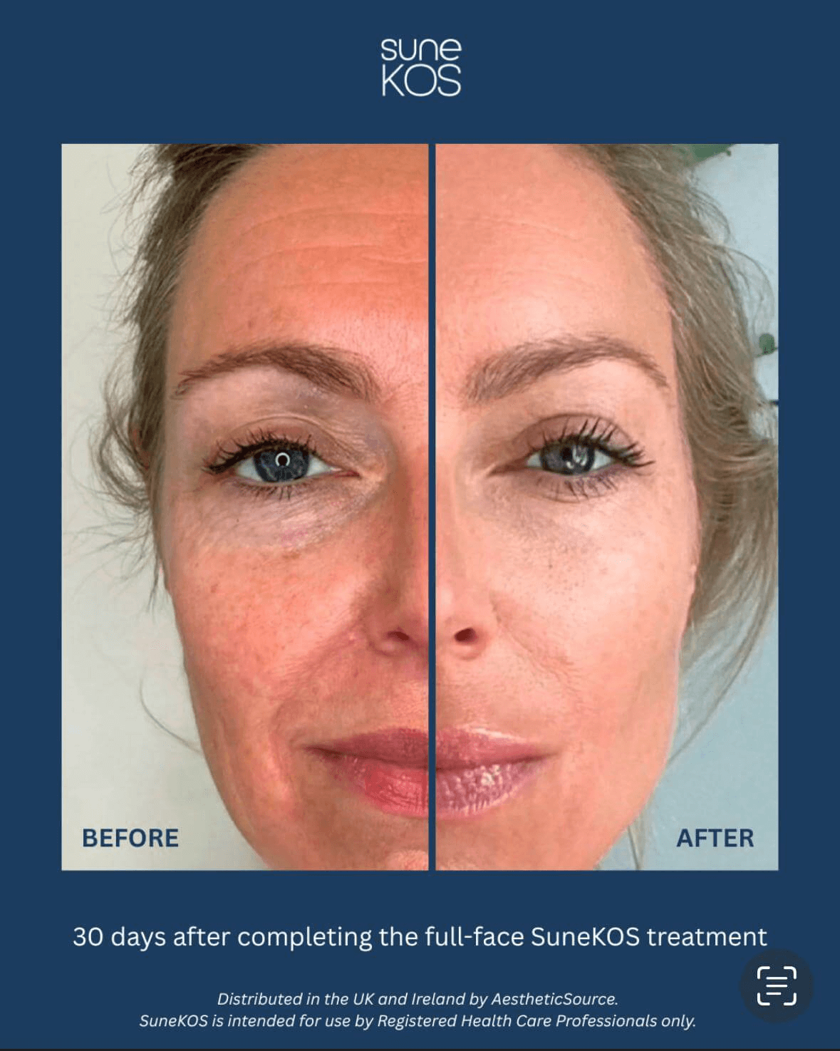  Skin Boosters
