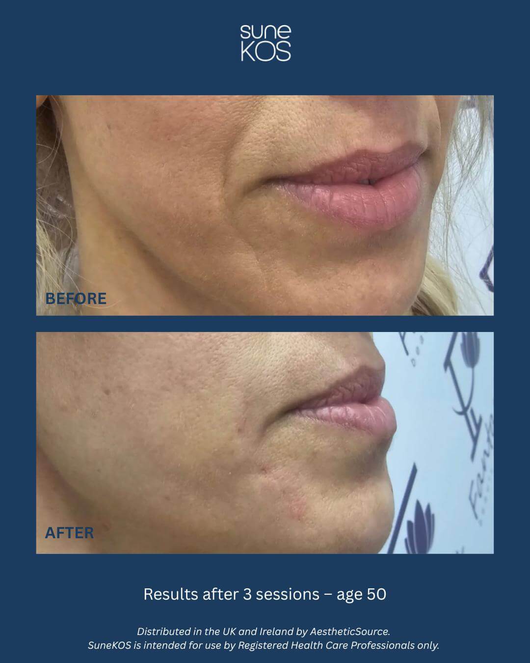 Skin booster injections Derby