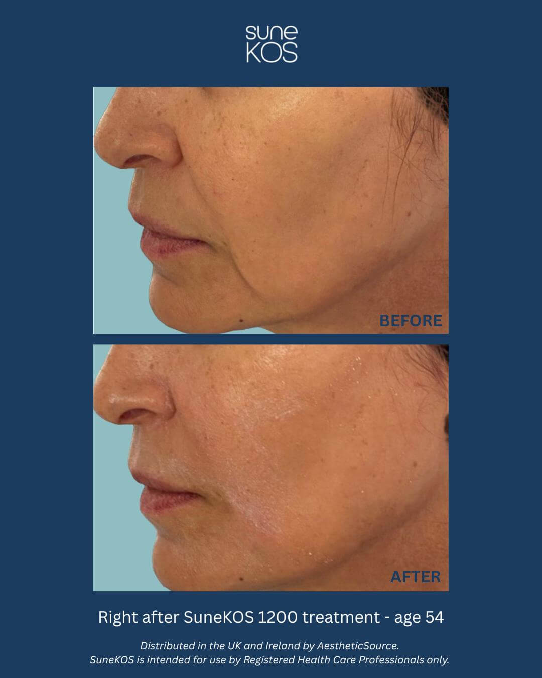 Injectable skin rejuvenation Derby