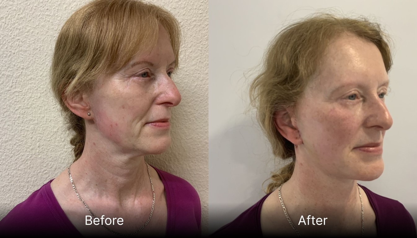 Before and after facelift treatment
