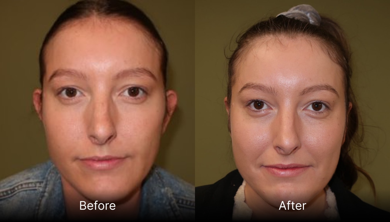Ear Correction, Otoplasty or Pinnaplasty