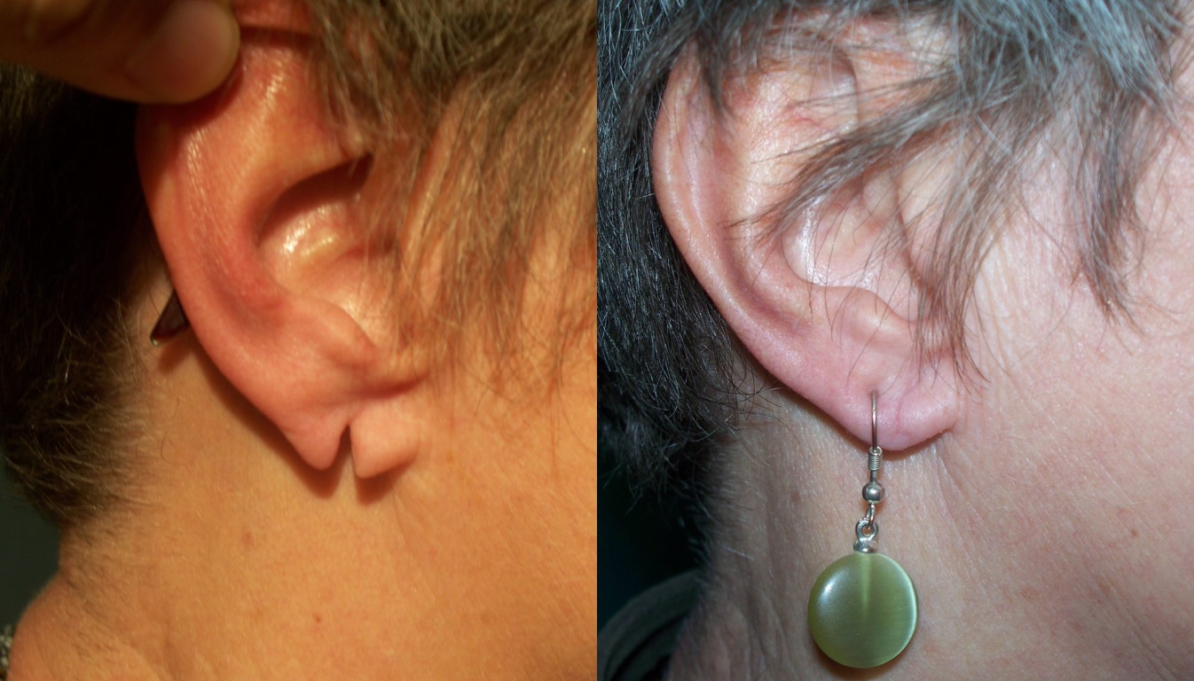 Split Earlobe Repair
