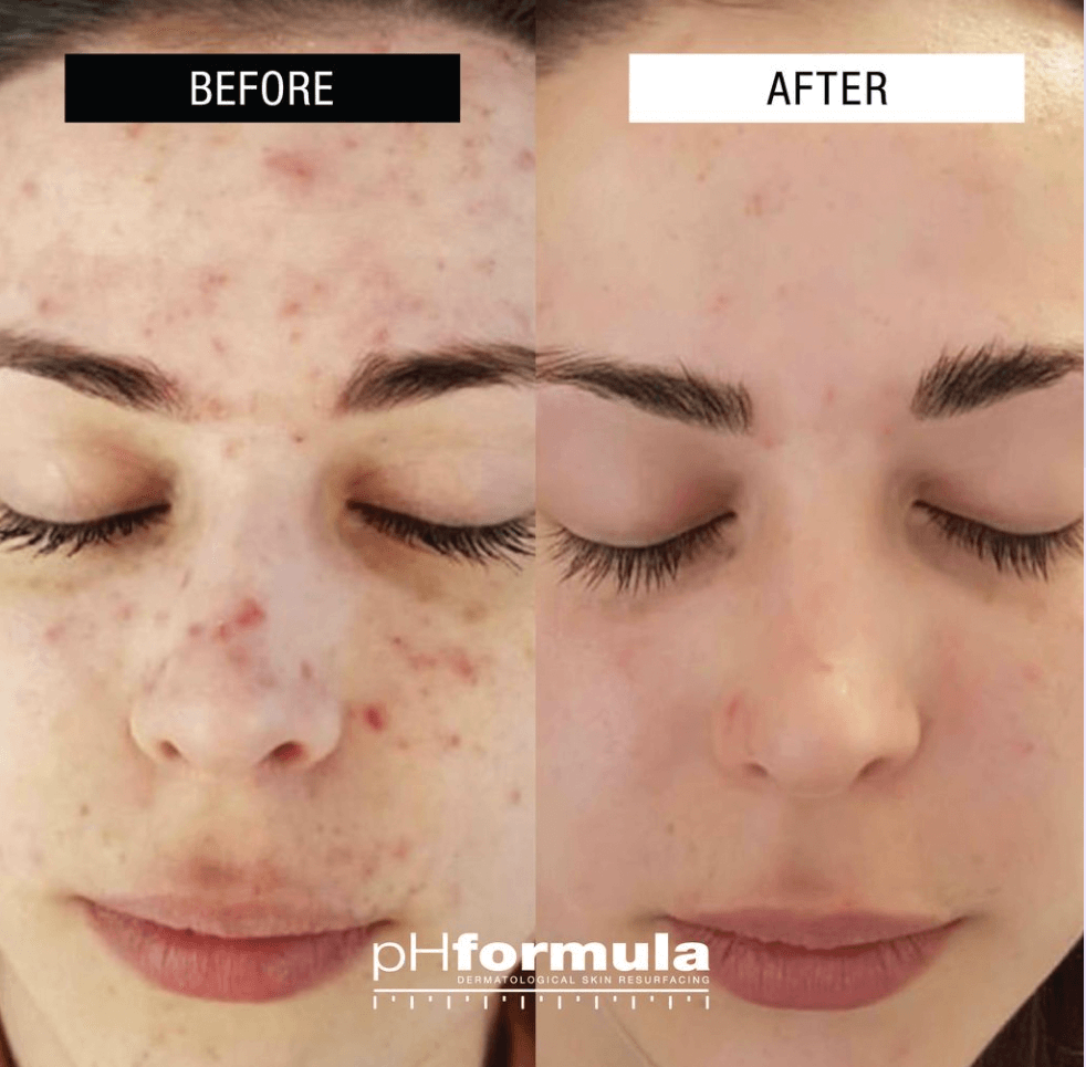 Cosmelan Peel Before After Results