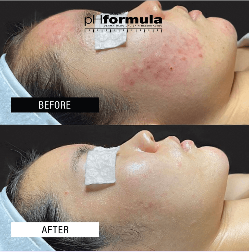 Cosmelan Peel Before After Results