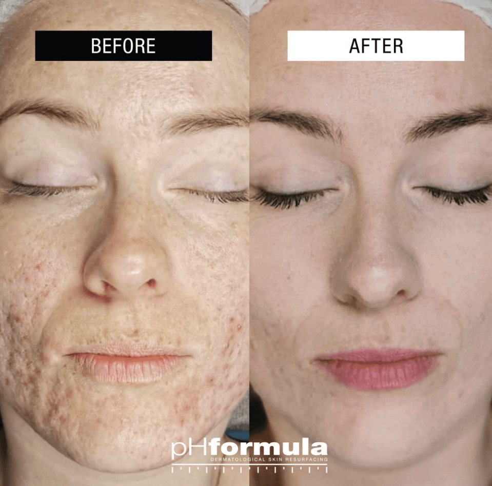 Cosmelan Peel Before After Results