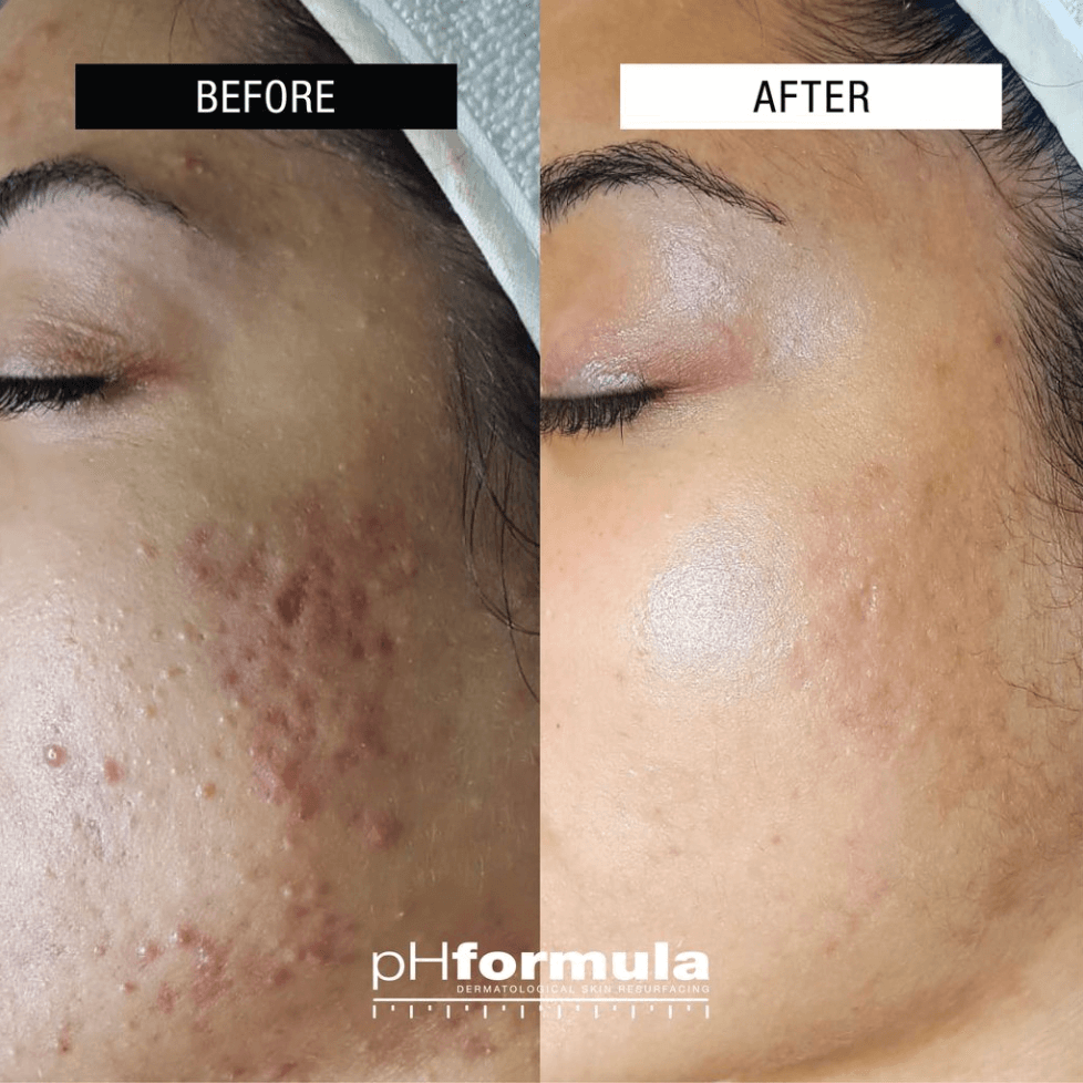 Cosmelan Peel Before After Results