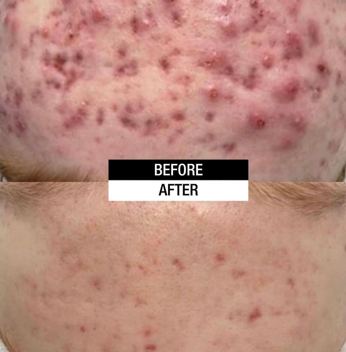 Cosmelan Peel Before After Results